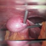 GALL-BLADDER-EXTRACTOR